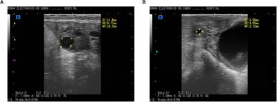 Alterations of Serum Metabolites and Fecal Microbiota Involved in Ewe Follicular Cyst